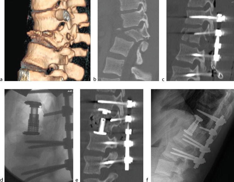 Traumatic Spondylolisthesis SpringerLink