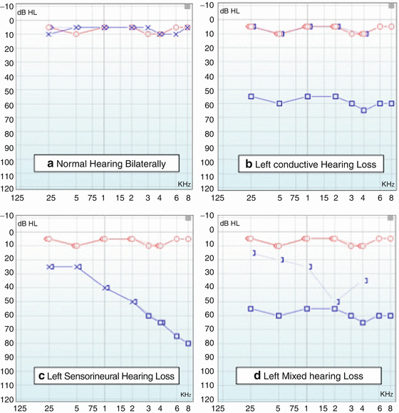 Audiometry Springerlink