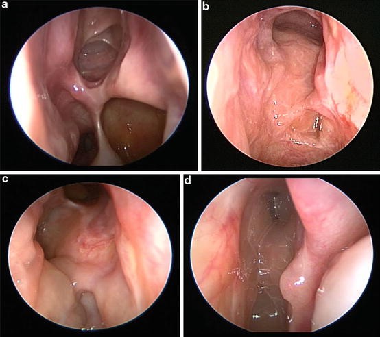 Allergic Fungal Rhinosinusitis Springerlink