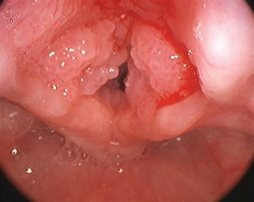 laryngeal papilloma lesions