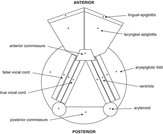 laryngeal papillomatosis diagram