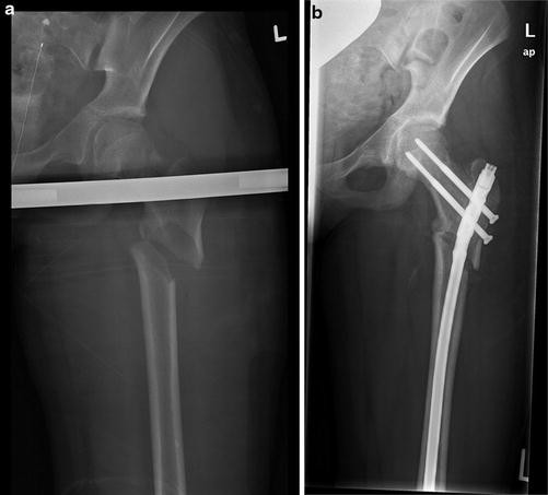 Pediatric Femur Fractures | SpringerLink