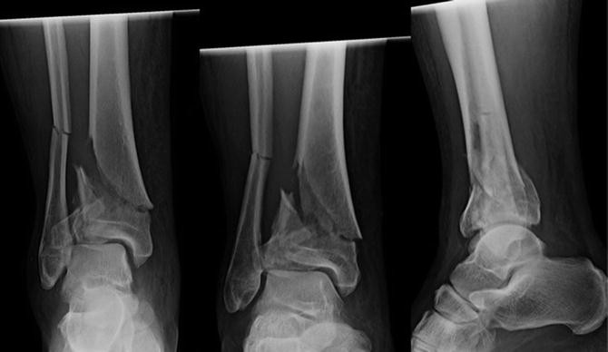 Tibial Pilon Fractures Springerlink