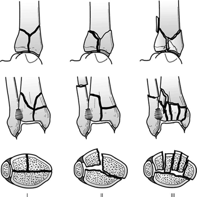 Tibial Pilon Fractures | SpringerLink