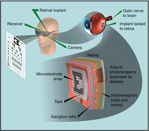 Epiretinal Prosthesis Springerlink