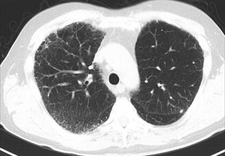 Autoimmune Lung Disease | SpringerLink