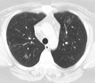 Autoimmune Lung Disease | SpringerLink