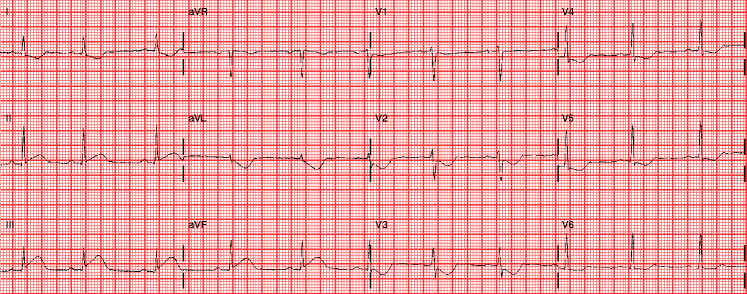 Myocardial Infarction | SpringerLink