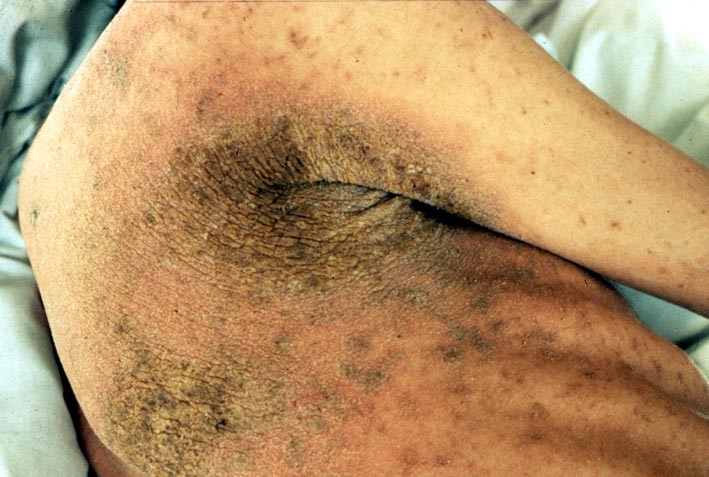 Scabies symptoms picture