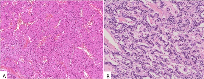 Neuroendocrine tumors with solid and trabecular growth patterns © https://link.springer.com/article/10.1007/s00428-021-03211-5