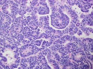 Wilms-2 tumor histology
