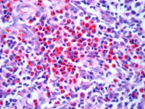 Light micrograph of a section through a lymph node affected by Hodgkin's lymphoma, large numbers of eosinophils are present.