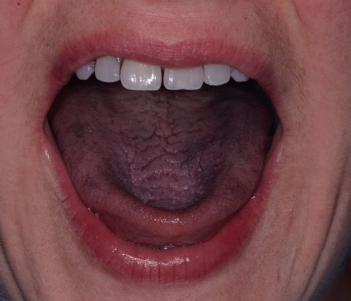 Charcoalcontaining dentifrices BDJ Team