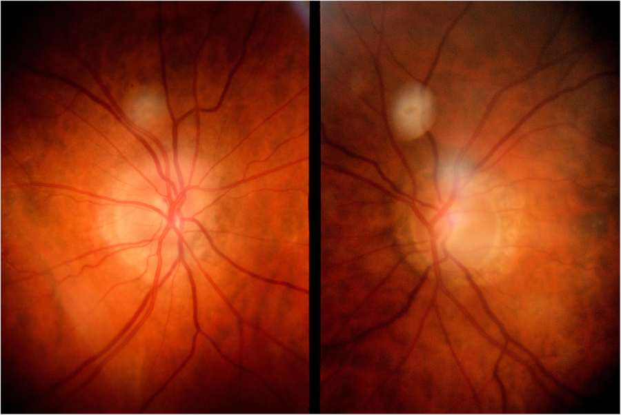 Acute emotional stress as a trigger for intraocular pressure elevation