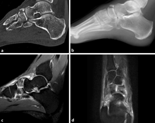 Welche typischen Fußfrakturen sollte der Radiologe kennen? | SpringerLink