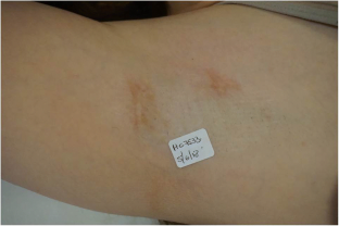 axillary hyperhidrosis