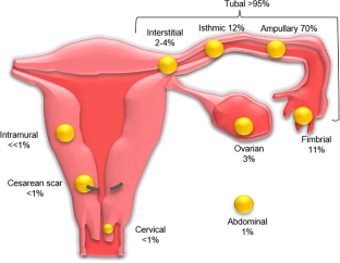 schematic representation of ectopic pregnancy