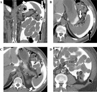 wandering spleen mayo clinic