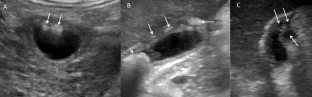 gallbladder sludge ultrasound report