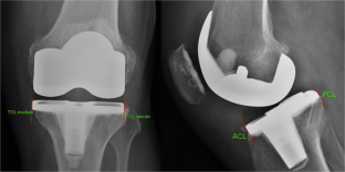 dissertation on knee arthroplasty
