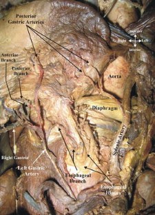 The clinical anatomy of the posterior gastric artery revisited