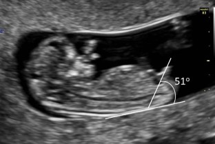 fetal gender assignment by first trimester ultrasound