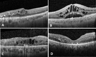 research articles on diabetic macular edema