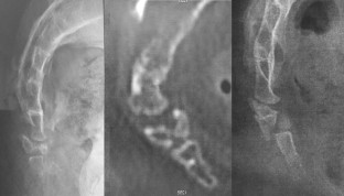 coccyx fracture coccyx fracture