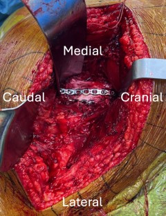 Standardized protocol during acetabular fracture surgery results in low ...