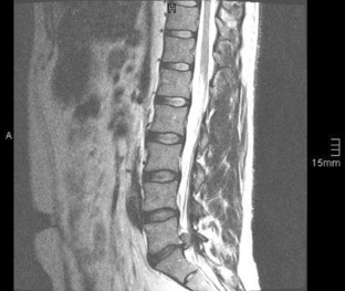 Lumbale Radikulopathie | SpringerLink