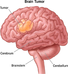 case study of a brain tumor patient