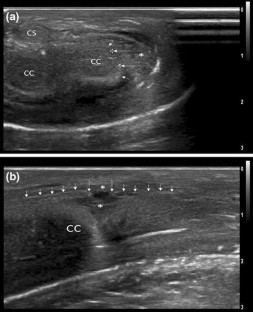 penile fracture imaging