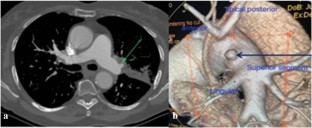 research articles on pulmonary tuberculosis