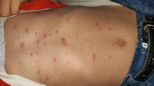 clinical presentation of varicella zoster virus