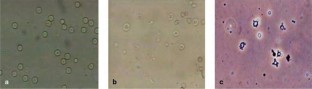 a) Monomorfe erytrocyten passend bij non-glomerulaire hematurie. De rode bloedcellen zijn uniform van grootte en vorm. b) Dysmorfe erytrocyten passend bij glomerulaire hematurie. De rode bloedcellen zijn klein, verschillend van grootte en vorm en hebben wisselende hemoglobine-inhoud. c) Acanthocyten. Dit zijn dysmorfe erytrocyten met ‘blebs’ op hun membraan, ook wel ‘Mickey Mouse oren’ genoemd. Ze passen typisch bij een glomerulaire origine van de hematurie.