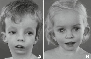 A: Een kind met hypo-H19 geassocieerd Silver-Russell-syndroom: triangulair gelaat met micro- en retrognathie, opvallende asymmetrie van het gelaat (inclusief ptosis rechterbovenooglid), naar beneden staande mondhoeken en een irregulaire tandenrij. (Toestemming van ouders verkregen voor publicatie.) B: Een kind met het Silver-Russell-syndroom geassocieerd met mUPD7. Weinig tot geen gelaatsdysmorfie, hartvormig symmetrisch gelaat met prominerend voorhoofd, en afstaande oorschelpen (links meer dan rechts). (Toestemming van ouders verkregen voor publicatie.)
