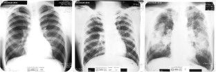 black lung disease research paper