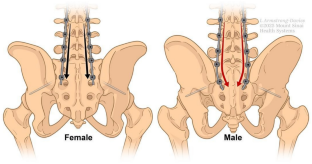 骨盤の性差が脊椎手術に与える影響を明らかに(Mount Sinai Study Highlights Sex-Based Pelvic Differences’ Effect on Spinal Screw, Rod Placement During Surgical Procedures)