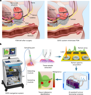前立腺腫瘍のリアルタイム悪性度分類を可能にする新たな術中ラマン散乱ナビゲーションシステムを開発(New Intraoperative Surface-enhanced Raman Scattering Navigation System Enables Real-Time Malignancy Grading of Prostate Tumors)