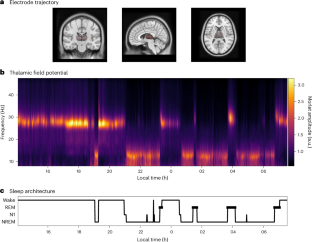 深部脳リズムが意識状態を識別することを発見 (Signals from the deep brain rhythms distinguish states of consciousness) 深部脳リズムが意識状態を識別することを発見 (Signals from the deep brain rhythms distinguish states of consciousness)