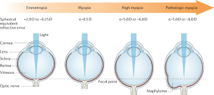 research papers on myopia