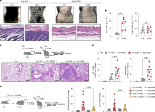 小児期に湿疹が始まる理由を解明（New Research Sheds Light on Why Eczema So Often Begins in Childhood）