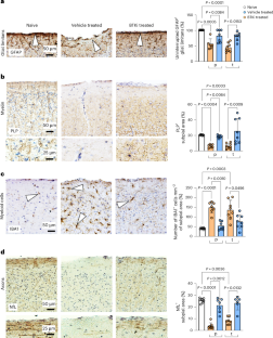 MS進行に関与する潜在的バイオマーカーを特定(Researchers identify potential biomarker linked to MS progression)