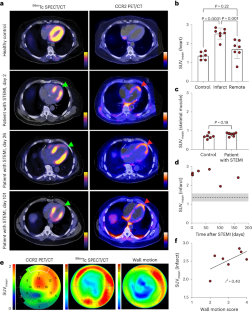 非侵襲的技術がヒト心臓の炎症細胞の可視化に役立つ(Noninvasive technique helps visualize inflammatory cells in human heart)