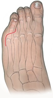 Transfer der Extensor-digitorum-longus-Sehne zur Behandlung des ...