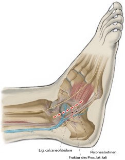 Periphere Talusfrakturen | SpringerLink
