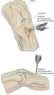 Verschiebeosteotomie der Tuberositas tibiae bei patellofemoraler ...