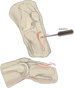 Verschiebeosteotomie der Tuberositas tibiae bei patellofemoraler ...