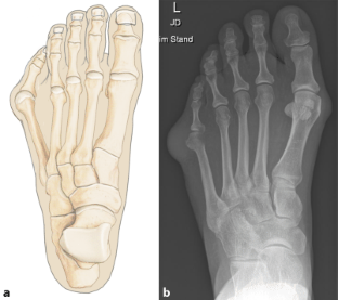 Minimally invasive bunionette correction | SpringerLink