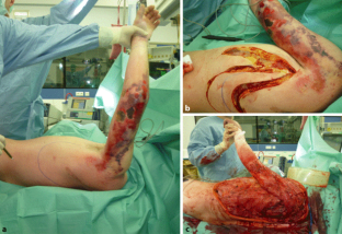 Nekrotisierende Fasziitis der oberen und unteren Extremität | SpringerLink